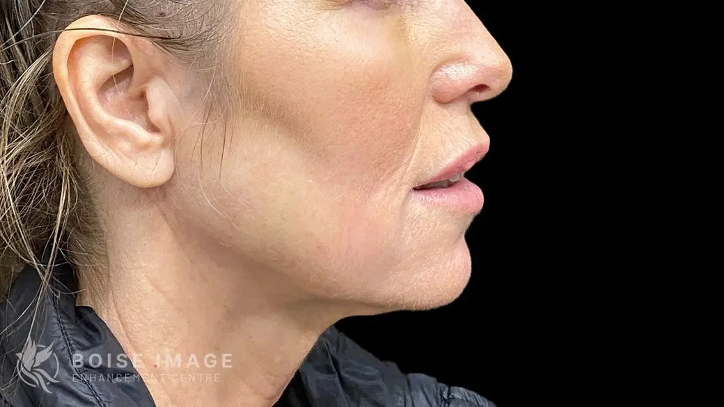 Lower Face Before