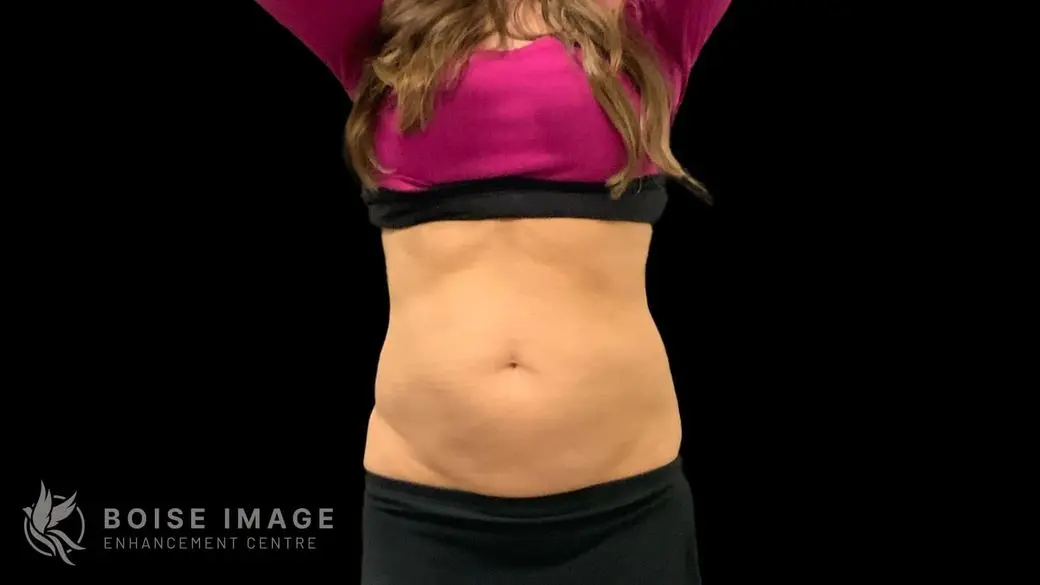 Flanks and Abdomen After