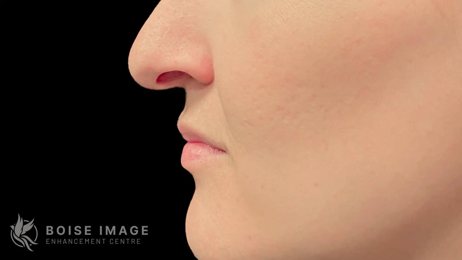 Lower Face After