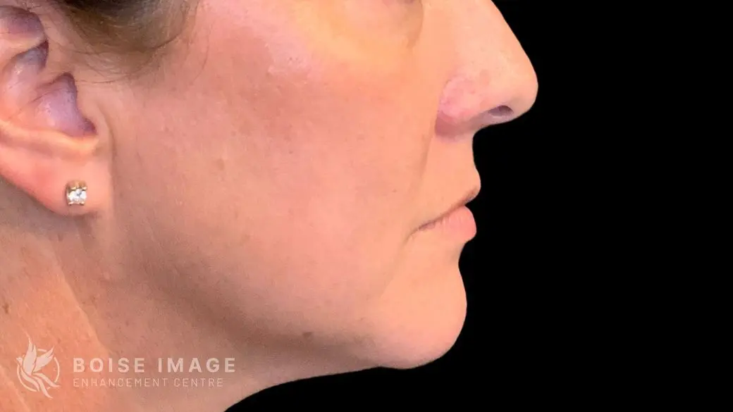 Lower Face Before