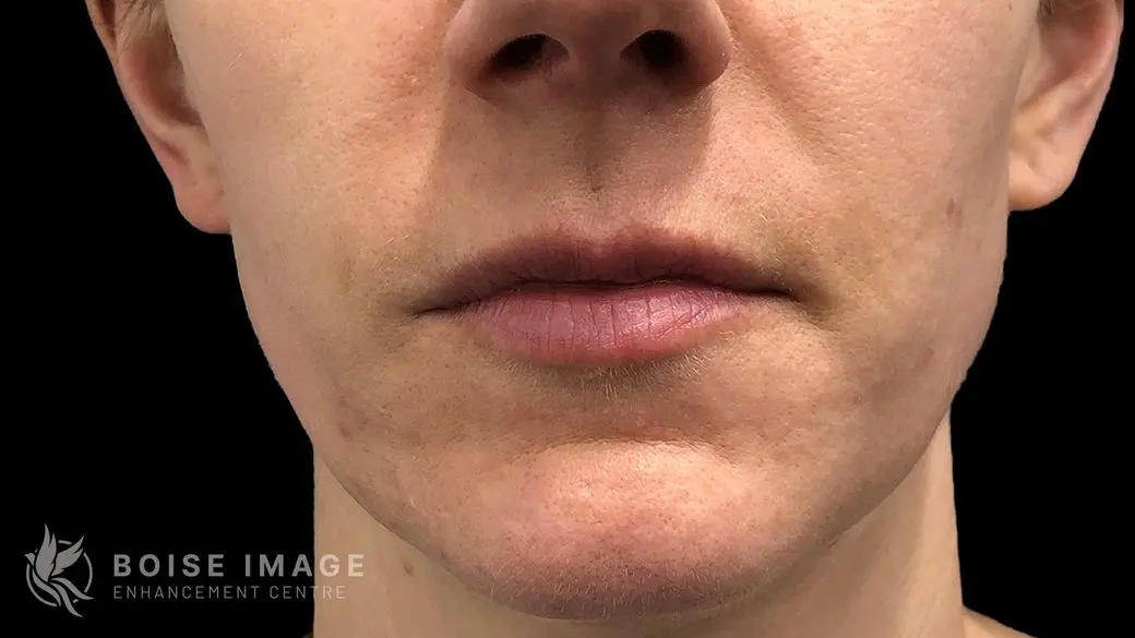 Lips Before