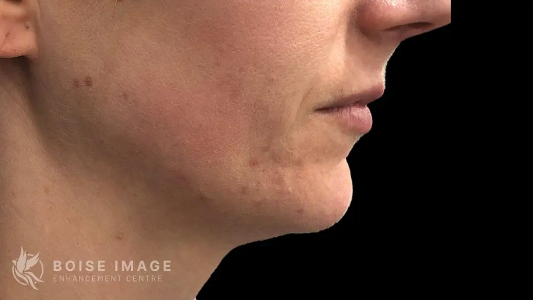 Lips Before