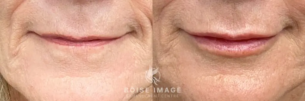 Before and after pictures of Restylane Kysse Lip Filler