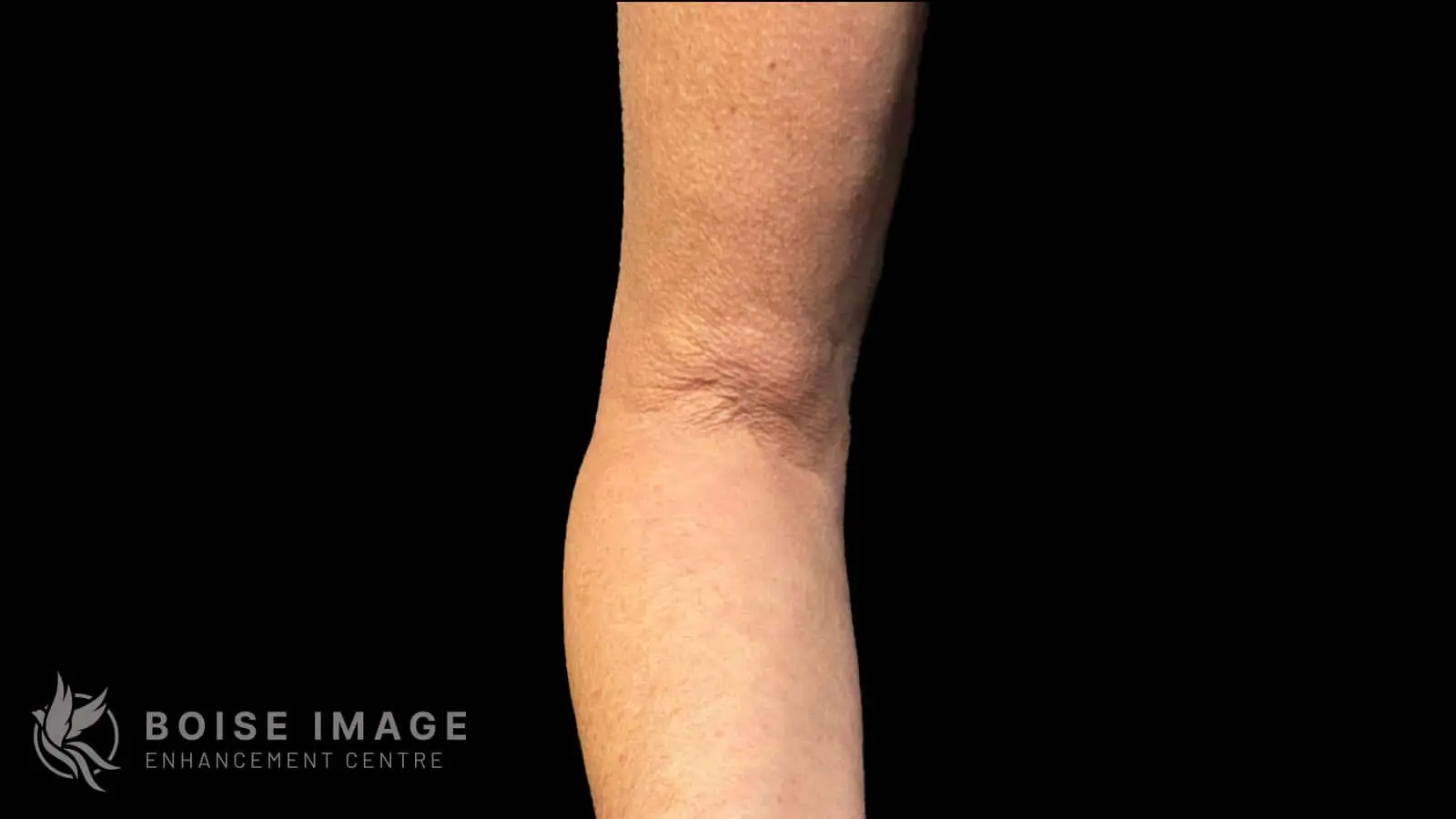 Right Arm After