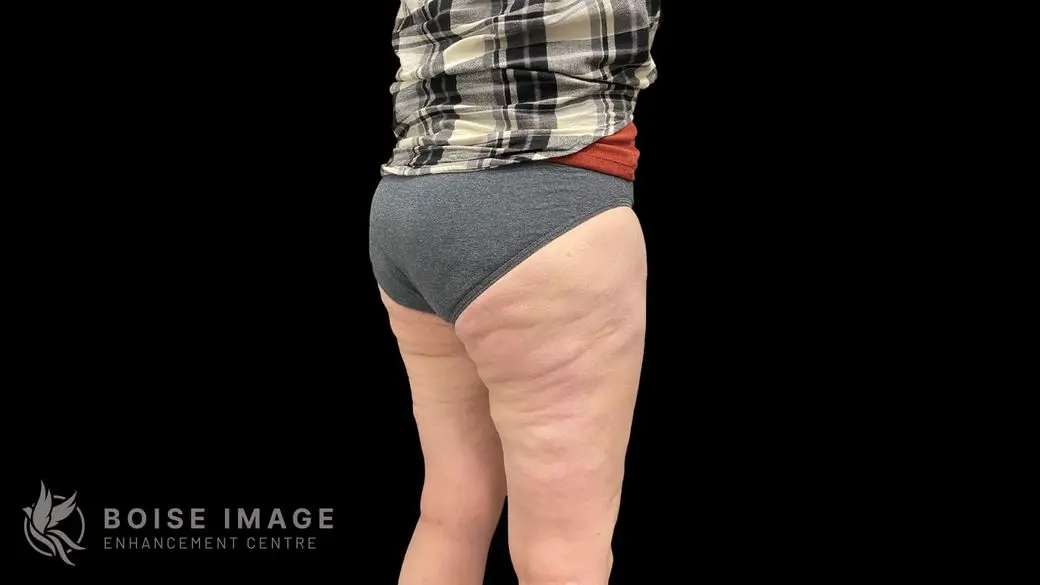 Outer Thighs After