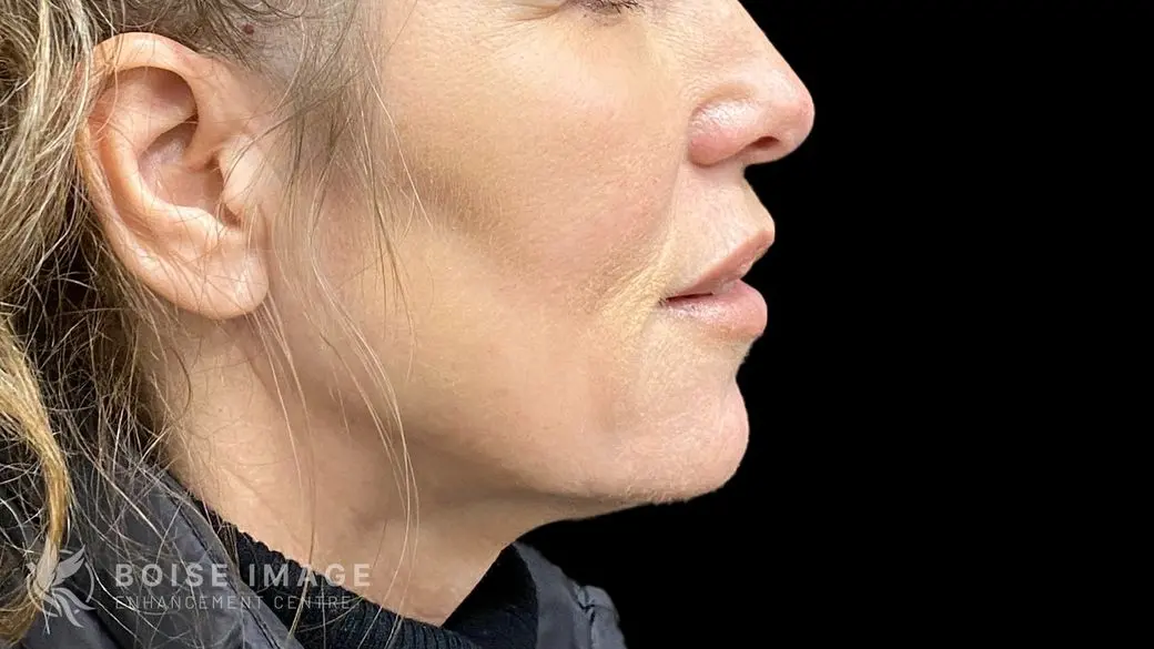 Lower Face After