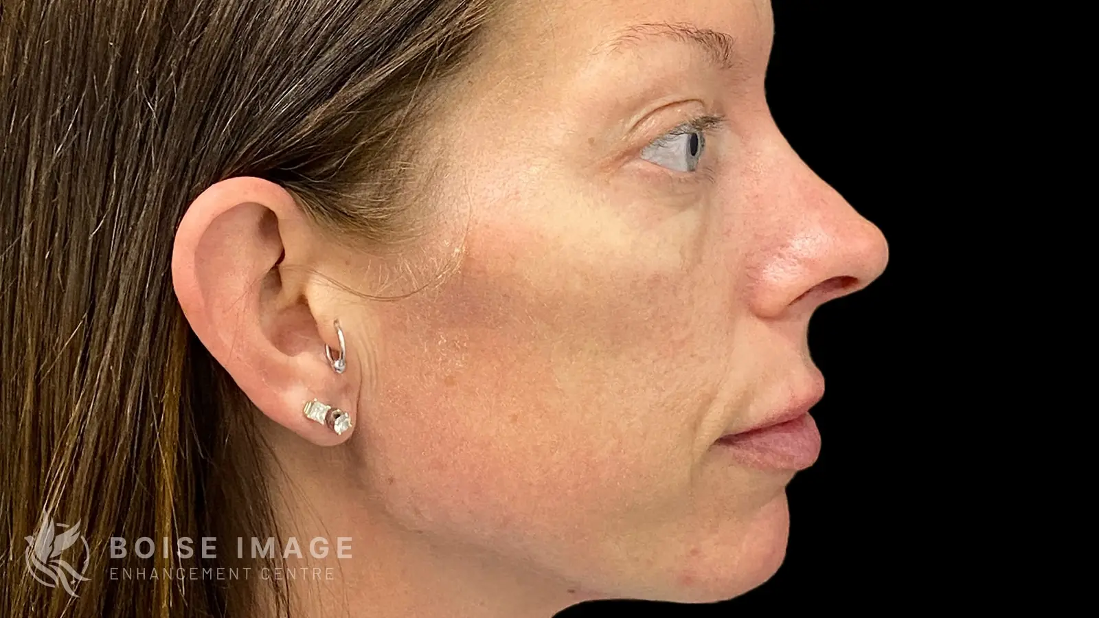 Cheeks Before