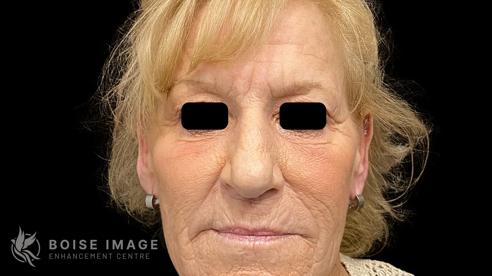 Facial Balancing Front After