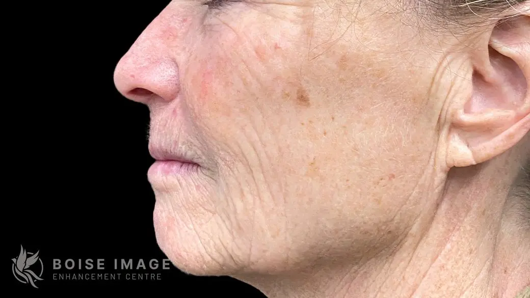 Lower Face After