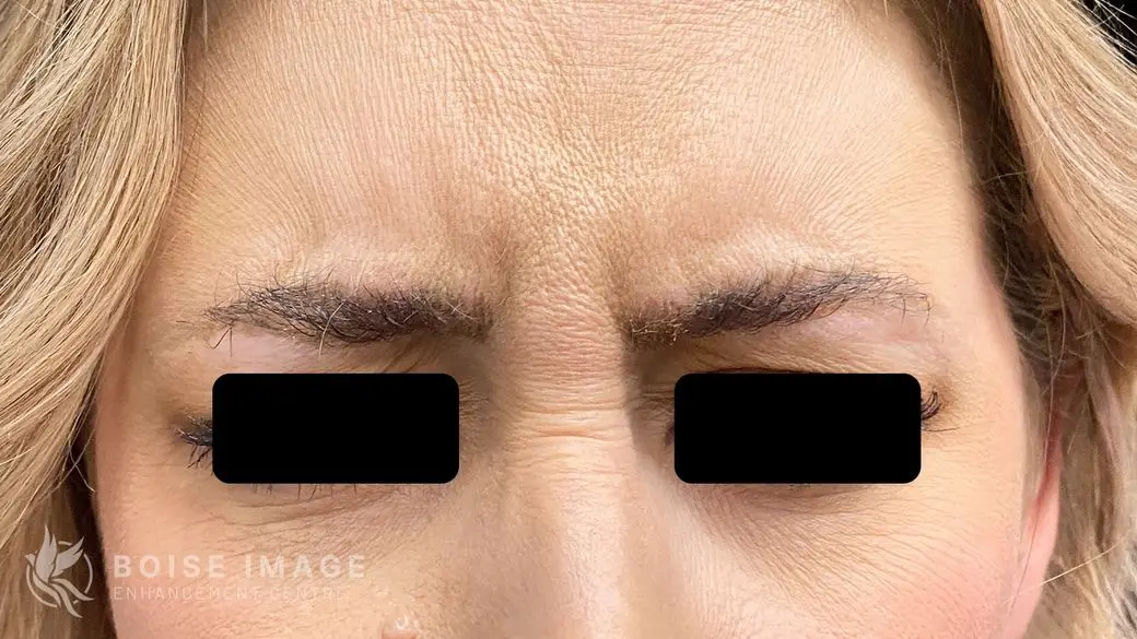 Glabella Before