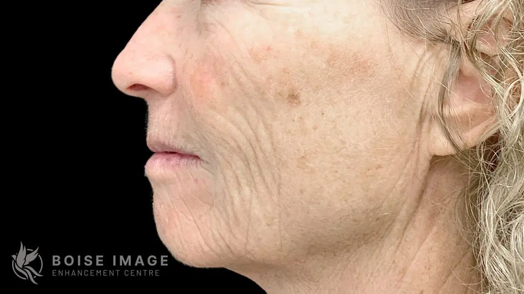 Lower Face Before