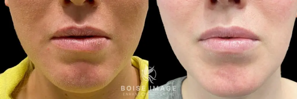 Lip Filler Refill Before and After - Treatment