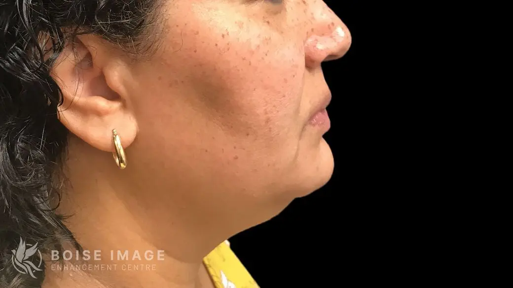 Kybella Before