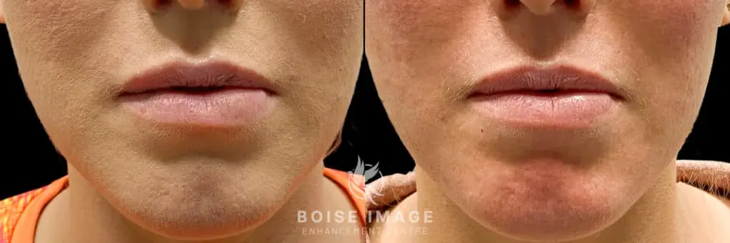 Lip Filler Dissolving Before and After - Treatment