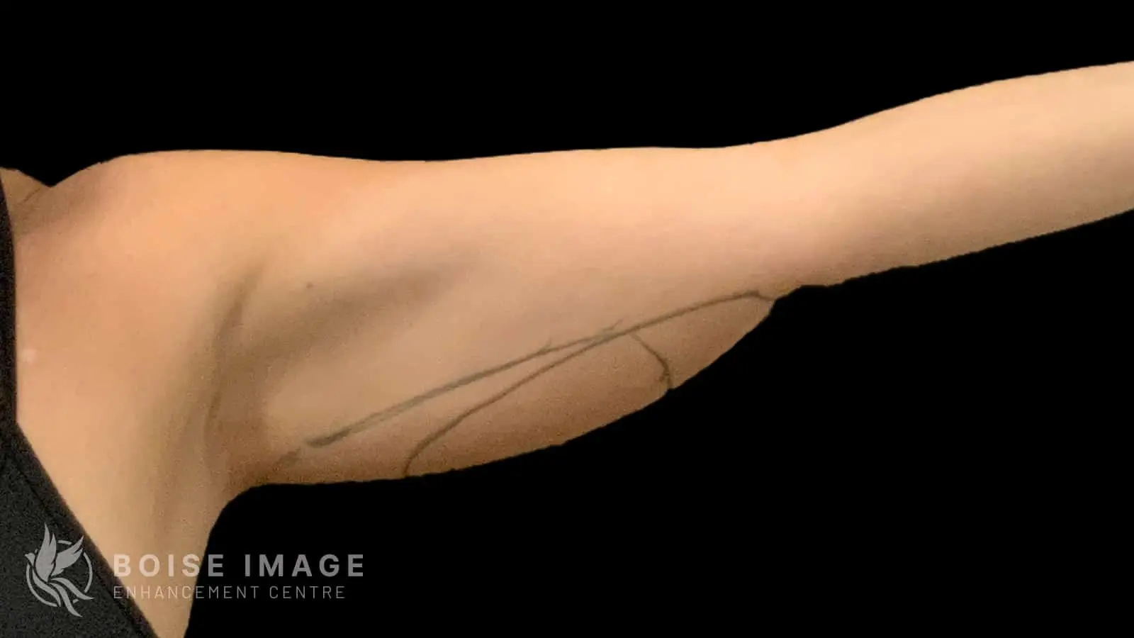 Left Arm Before
