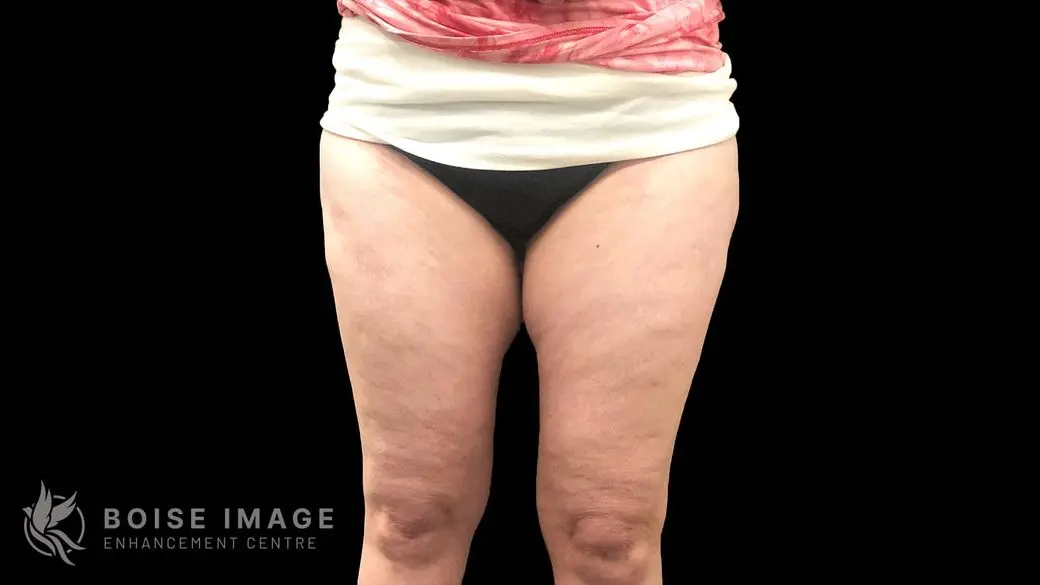 Outer Thighs Before