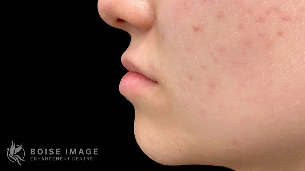 Lips Before