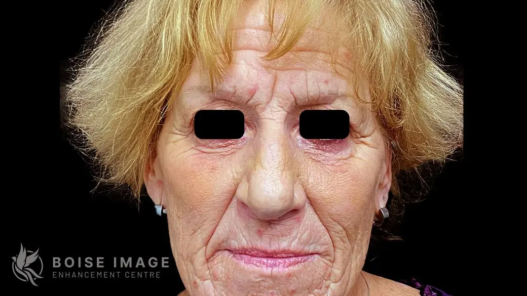 Facial Balancing Front Before