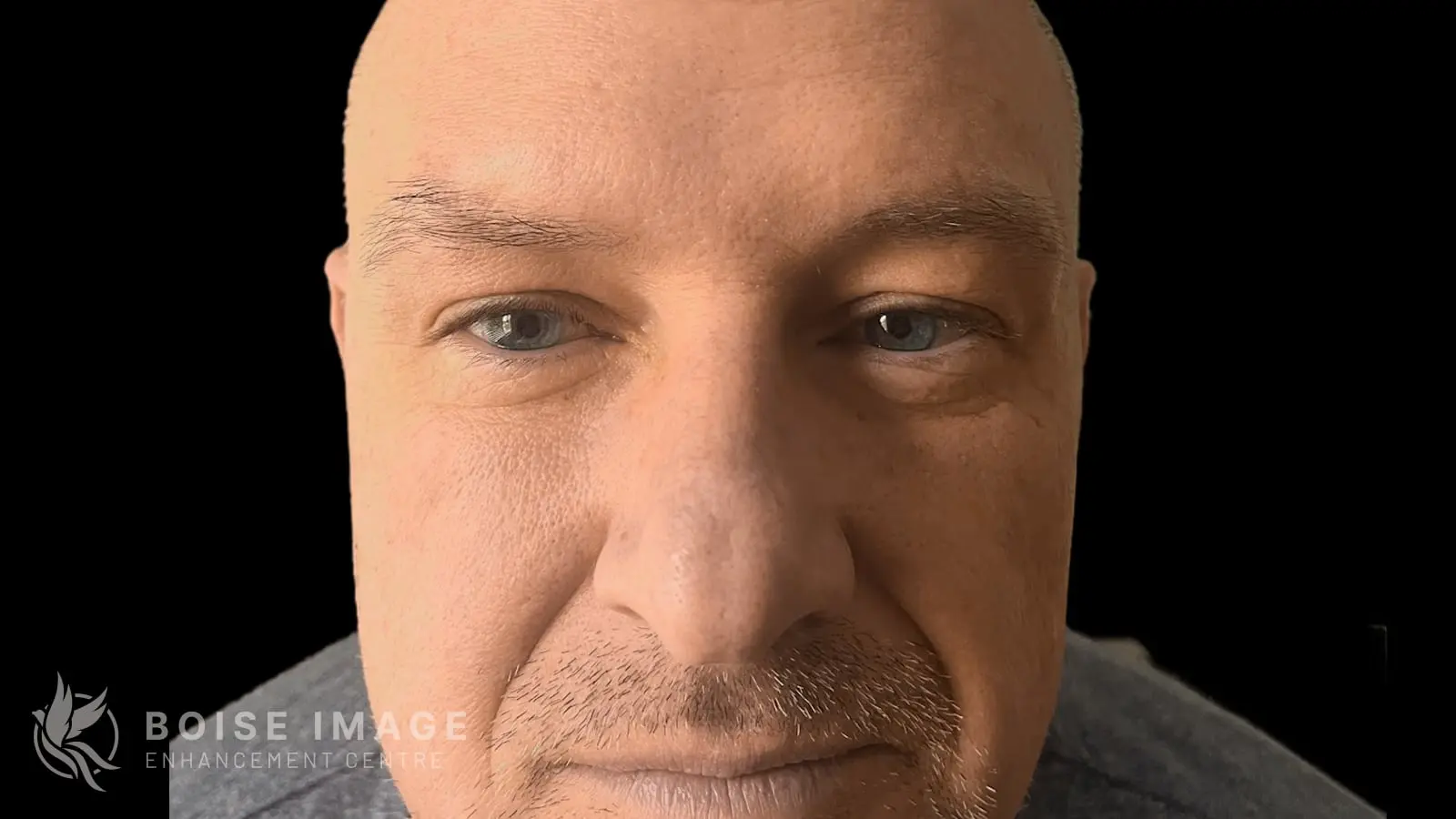Forehead Dent After