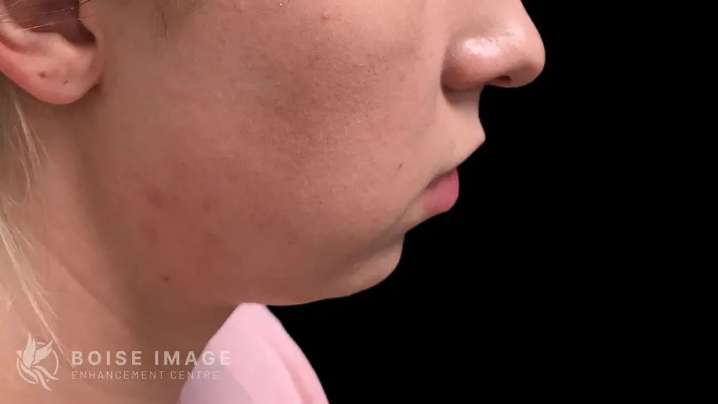 Kybella Before
