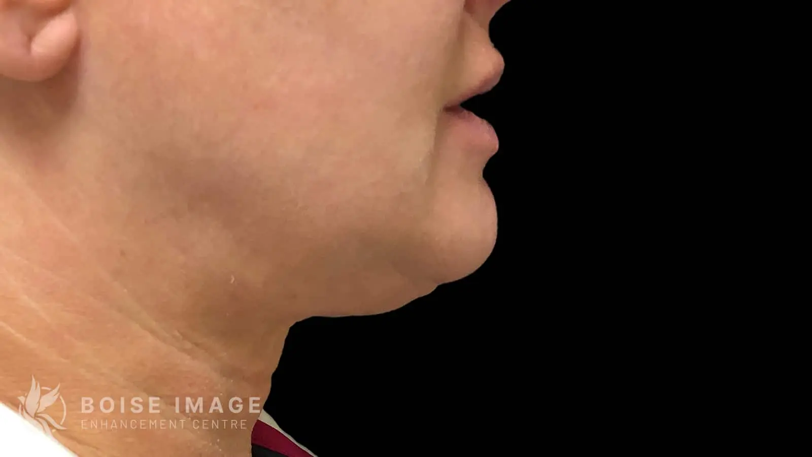 Lower Face After