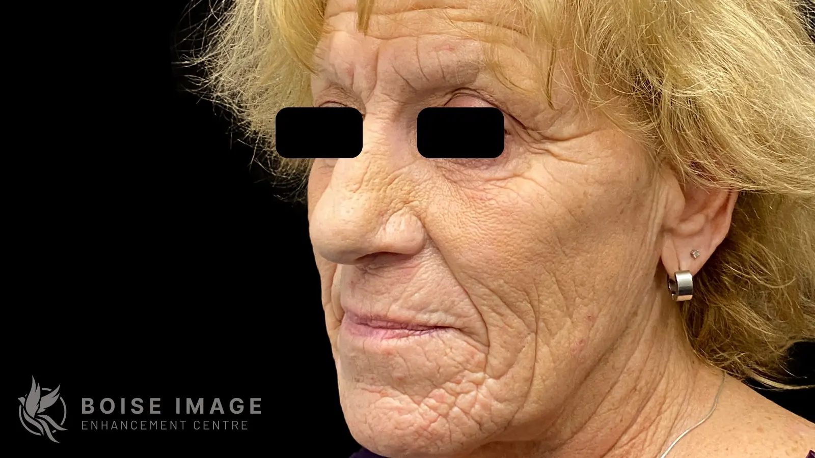 Facial Balancing Side Before
