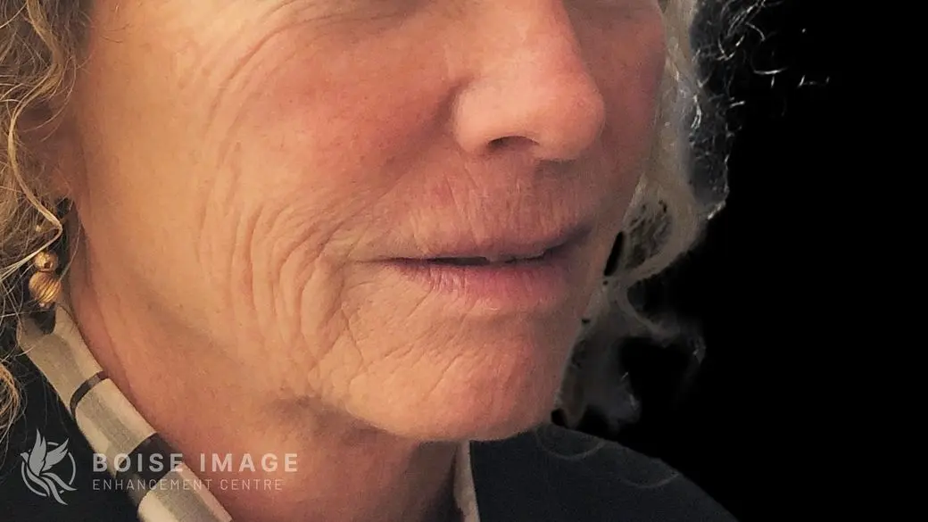 Lower Face After