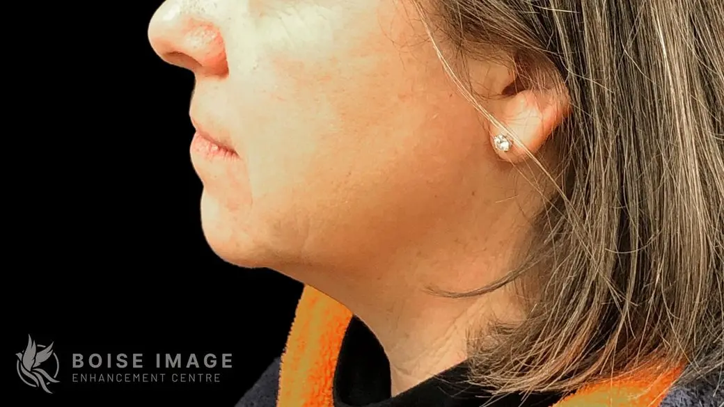 Kybella After