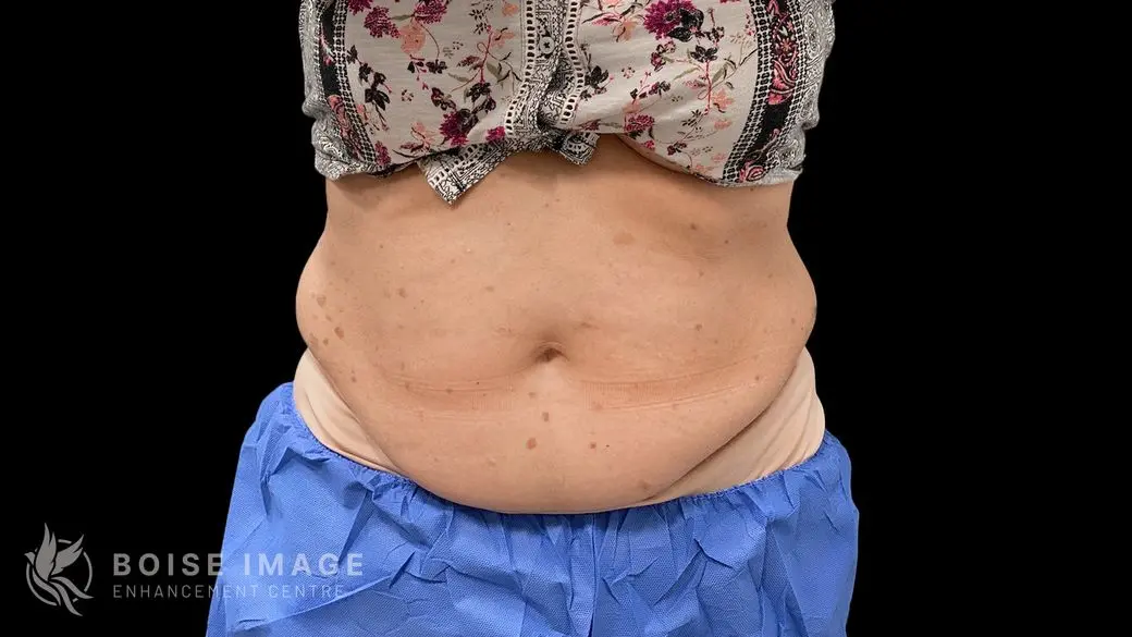 Abdomen Before