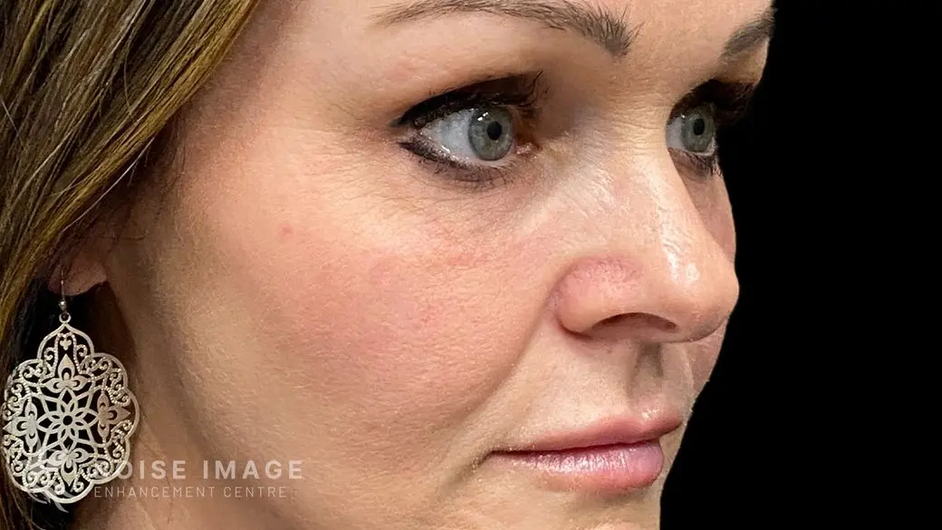 Under Eyes After
