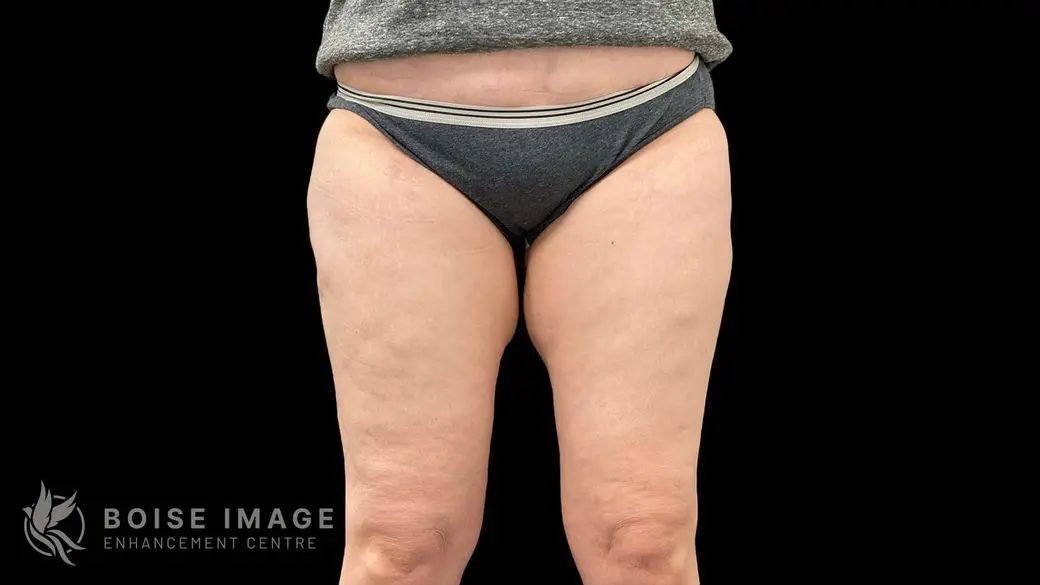 Outer Thighs After