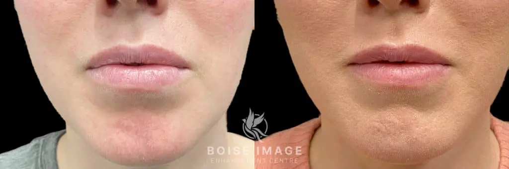 Lip Filler Refill Before and After - Treatment