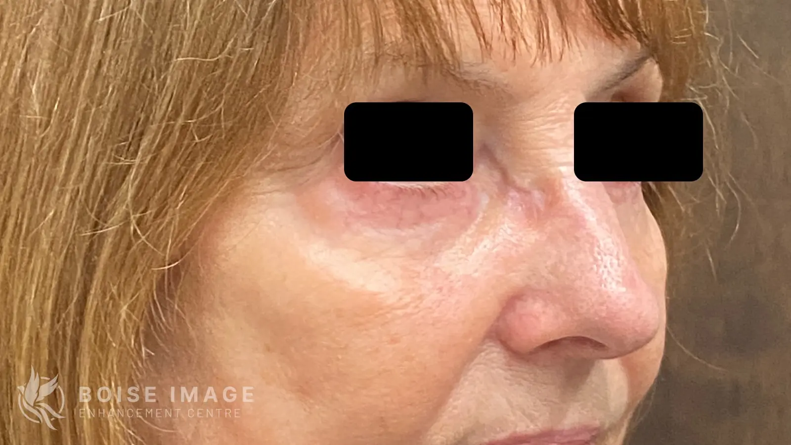 Under Eyes After
