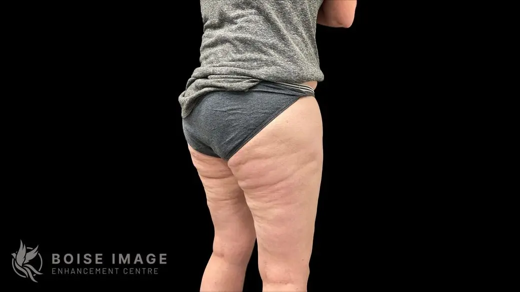 Outer Thighs Before