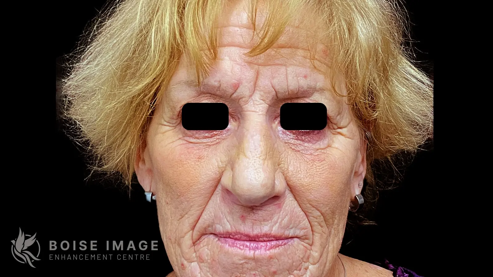 Facial Balancing Front Before