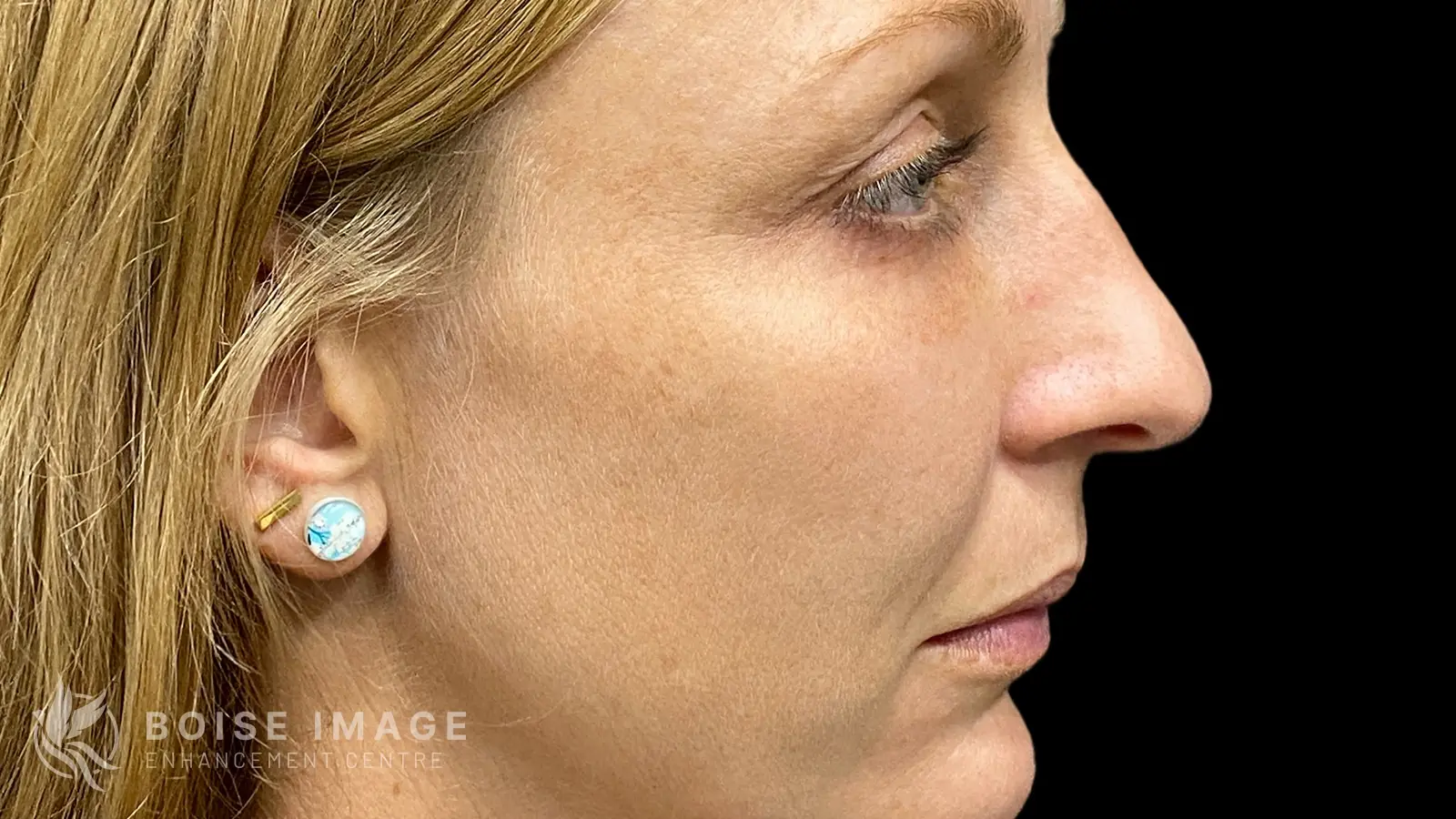 Facial Balancing Side After