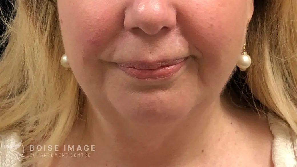 Kybella After
