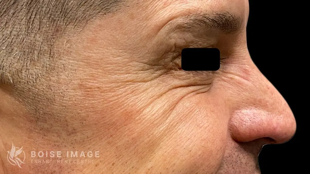 Crows Feet After