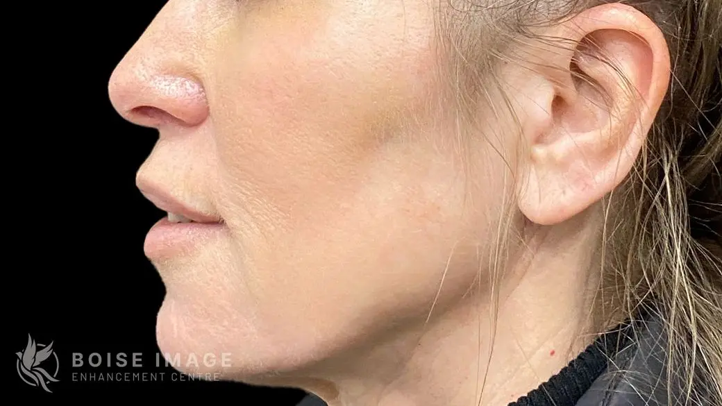 Lower Face After