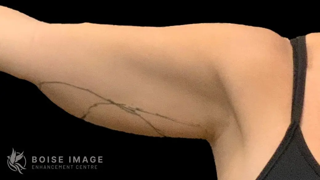 Right Arm Before