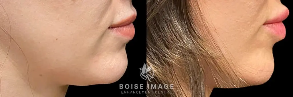 Restylane Kiss Before and After