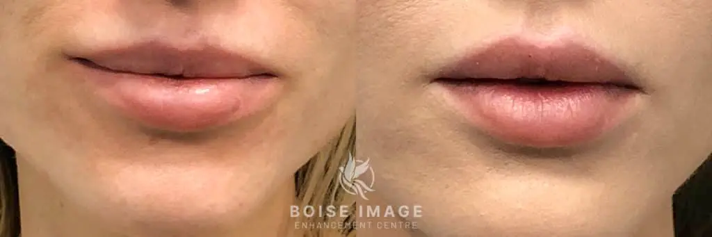 Lip Filler Reset Refill Before and After