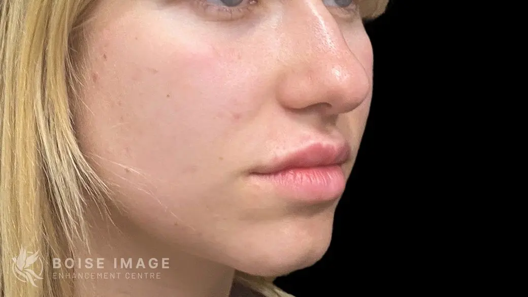Lips After