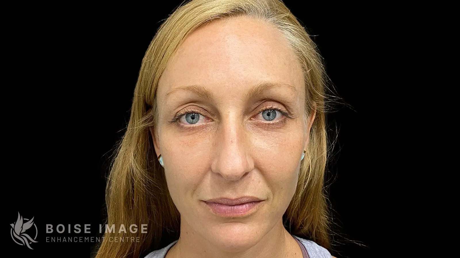 Facial Balancing Front After