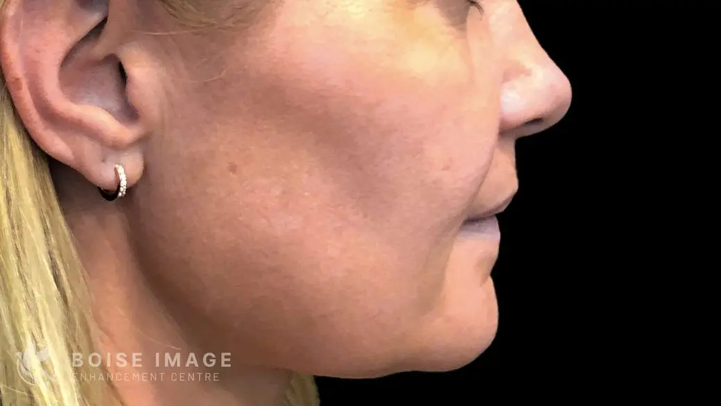 Lower Face Before