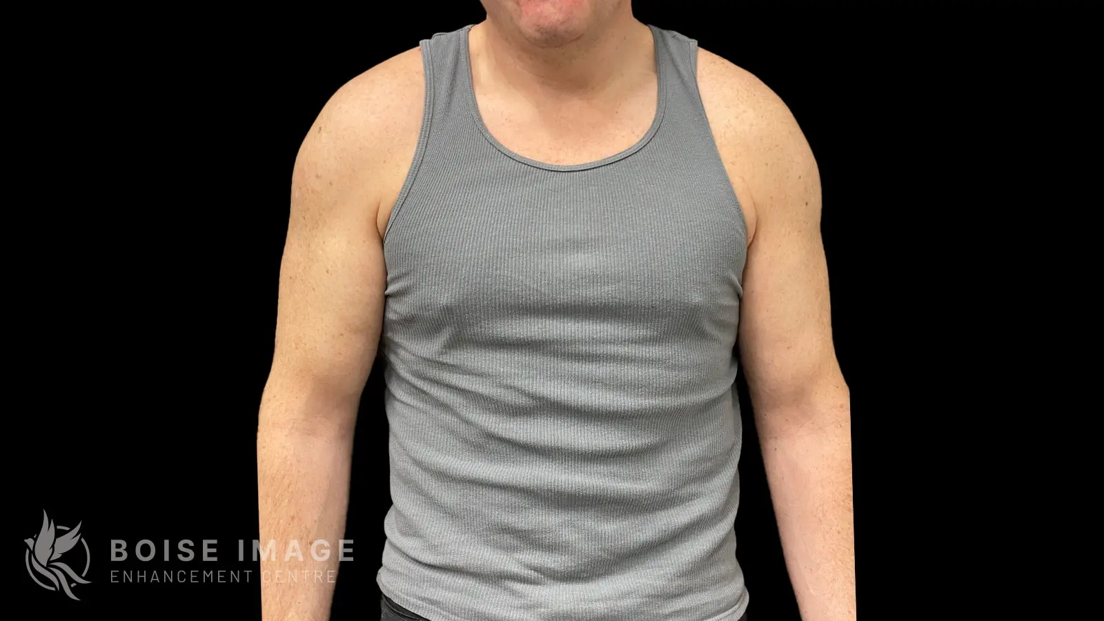 Before Anterior Full