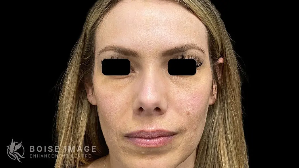 Cheeks and Under Eyes Before
