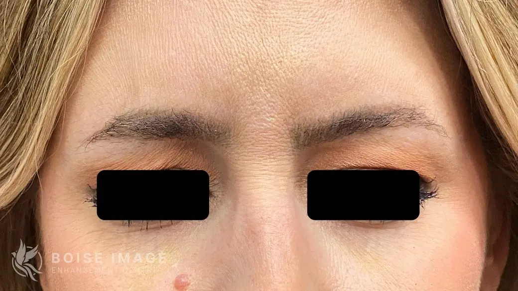 Glabella After