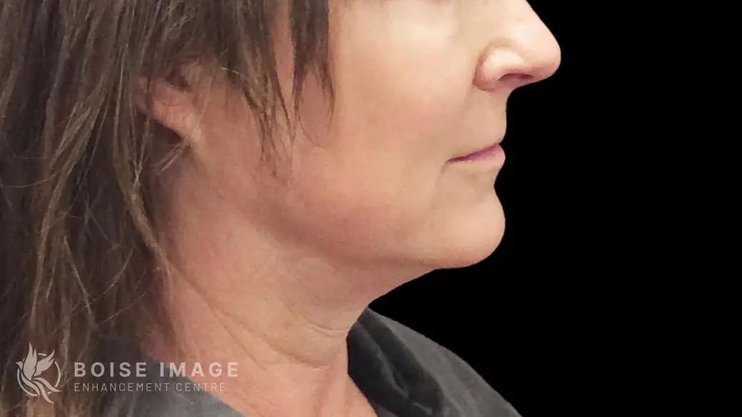 Jawline Chin Before