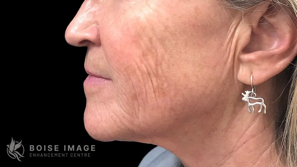 Lower Face Before